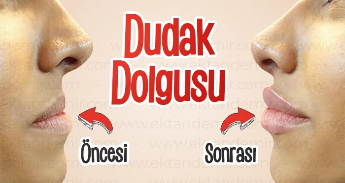 dudak dolgusu öncesi sonrası