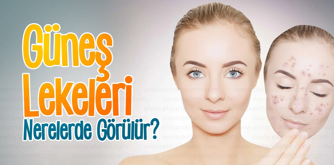güneş lekeleri nerelerde görülür