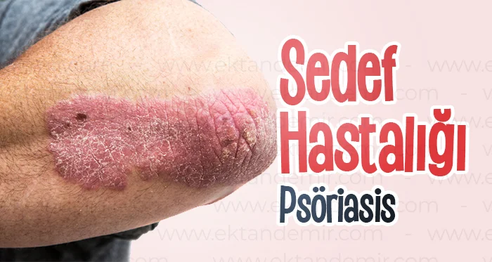 Psöriasis (Sedef Hastalığı)