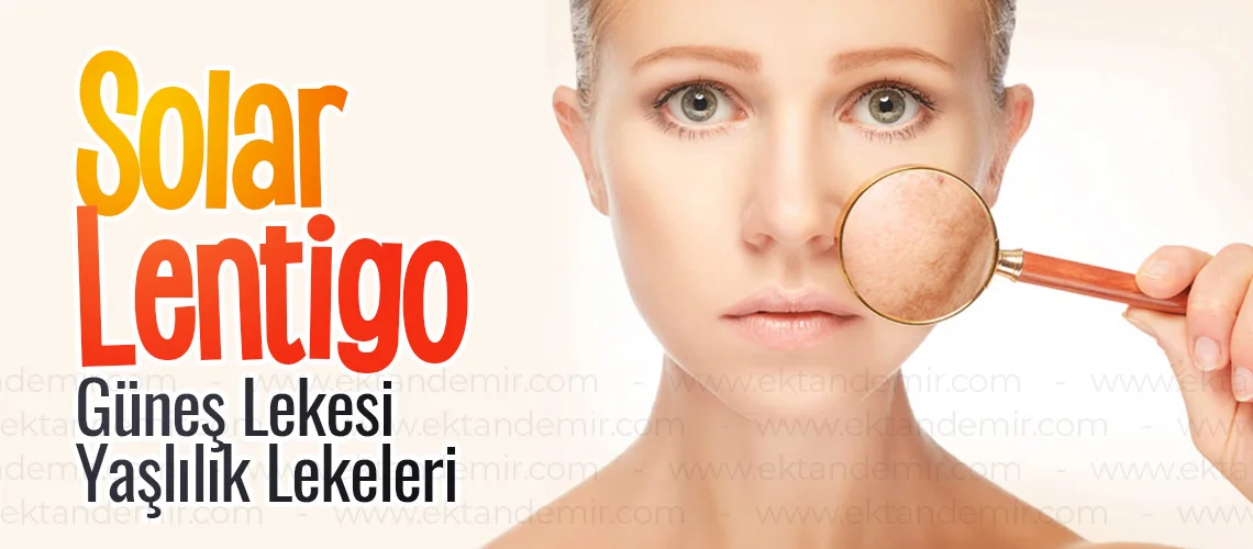 Solar Lentigo İstanbul