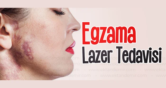 Egzema Lazer Tedavisi