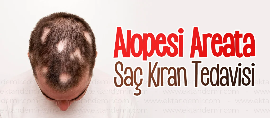 Alopesi Areata İstanbul