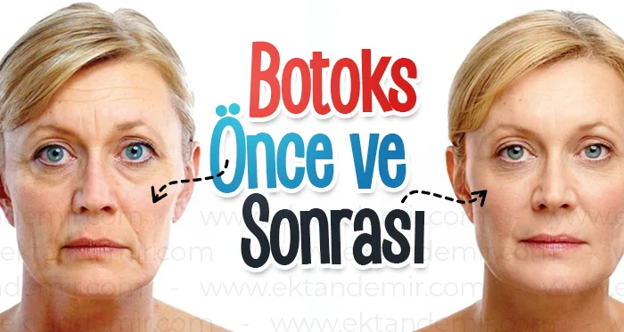 Botoks Önce ve Sonrası