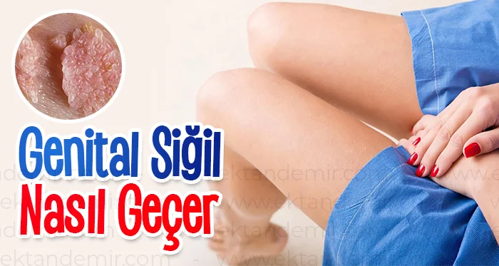 Genital Siğil Nasıl Geçer?