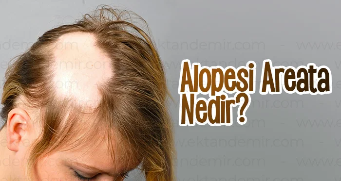 Alopesi Areata Nedir?