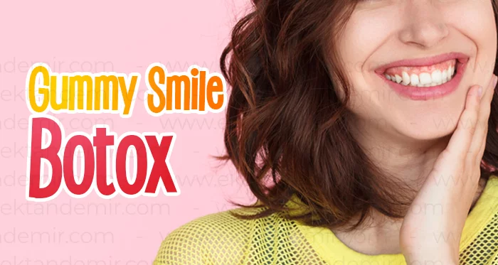 Gummy Smile Botox