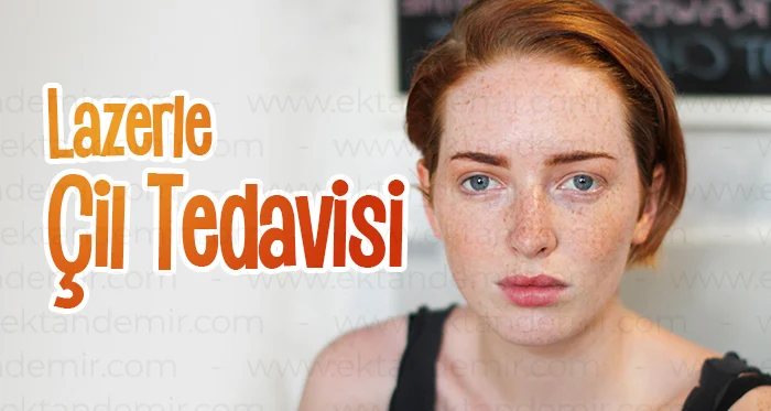 Lazerle Çil Tedavisi