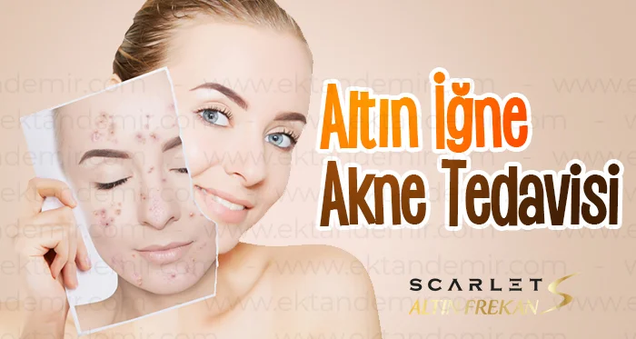 Altın İğne Akne Tedavisi