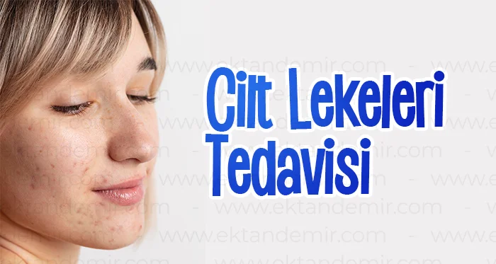 Cilt Lekeleri Tedavisi