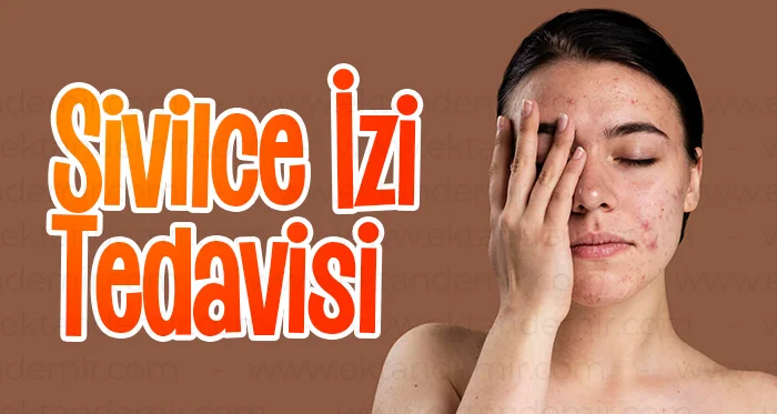 Sivilce İzi Tedavisi