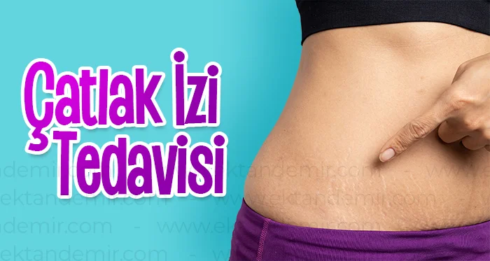 Çatlak İzi Tedavisi