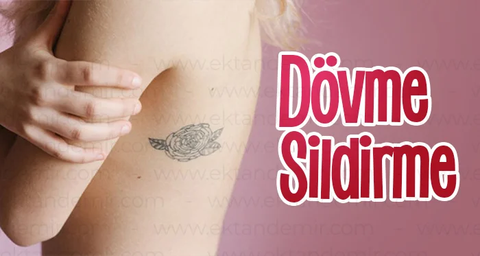 Dövme Sildirme
