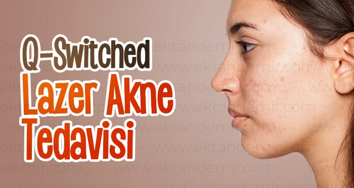 Q-Switched Lazer Akne tedavisi