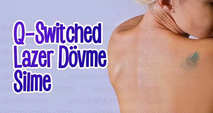Q-Switched Lazer Dövme Silme