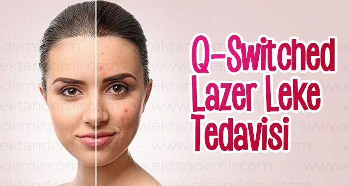 Q-Switched Lazer Leke Tedavisi
