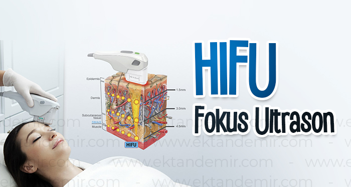 HIFU Fokus Ultrason