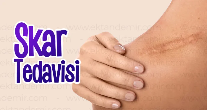 Skar Tedavisi İstanbul