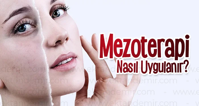 Mezoterapi Nasıl Uygulanır?