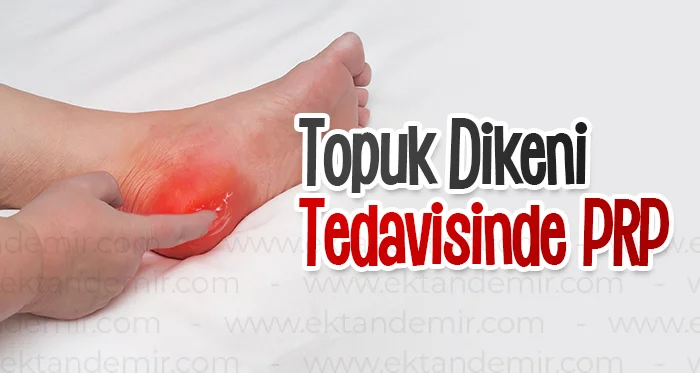 Topuk Dikeni Tedavisinde PRP
