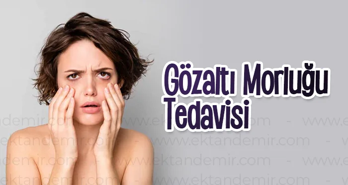 Gözaltı Morluğu Tedavisi