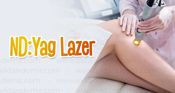 ND:Yag Lazer
