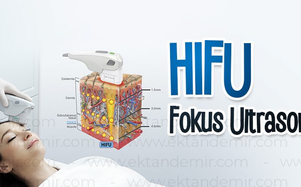 Fokal Odaklı Ultrason (HIFU)