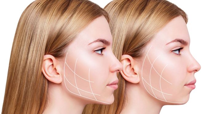 Jawline Dolgusu Öncesi Sonrası