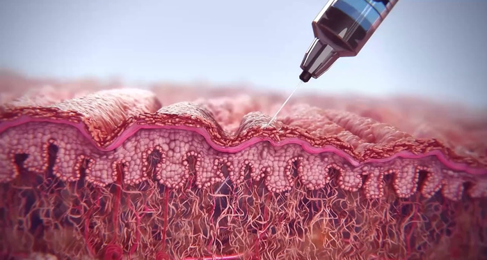 Sıvı Yüz Germe PLLA Nedir?